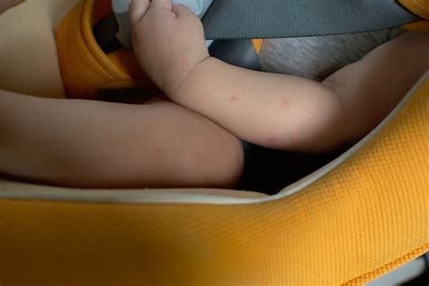 Cara Menghilangkan Bekas Gigitan Nyamuk pada Anak: Tips Ampuh & Playlist Musik